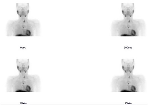 Sestamibi scan: hyperactive parathyroid tissue in the retrosternal area.