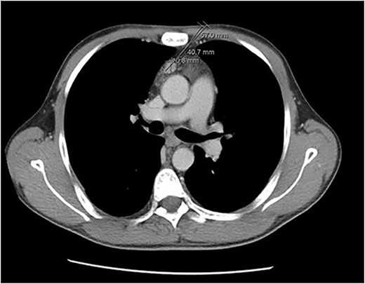 Chest CT revealing a retrosternal lesion measuring 57 mm anterior to the ascending aorta.