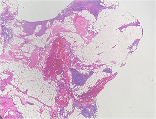 Multiple nodules of hypercellular parathyroid tissue within unremarkable thymic tissue.