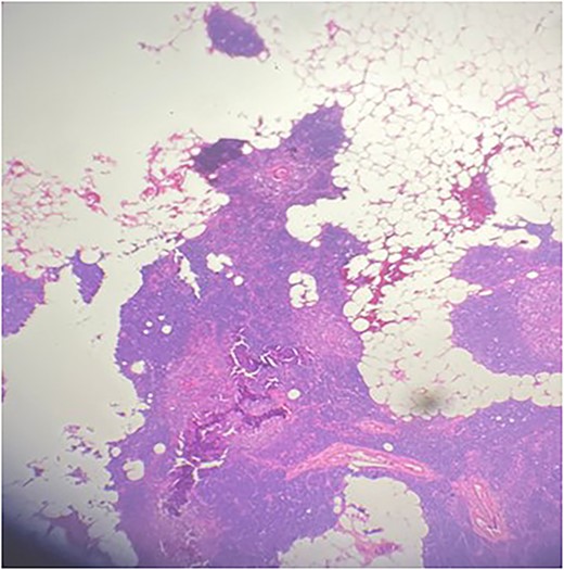 Multiple nodules of hypercellular parathyroid tissue within unremarkable thymic tissue.