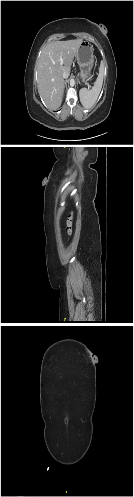 CT scanned abdomen and pelvis showing an anterior left upper abdominal wall skin-based, pedunculated, enhancing soft tissue nodule with a large stalk