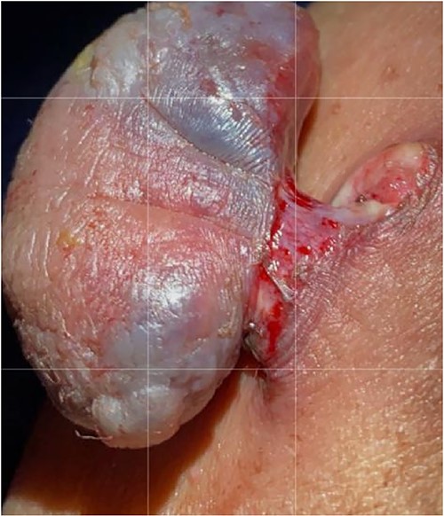 Macroscopic examination: the specimen received in formalin labeled with the patient’s name, MN, as ‘infected skin lesion, left upper abdomen.’ It consisted of skin measuring 3.0 cm × 1.2 cm overlying fibro-fatty tissue measuring 3.0 cm × 2.0 cm × 1.0 cm with polypoid skin lesion measuring 3.5 cm × 2.0 cm × 1.0 cm. The lesion is 1.2 cm away from the deep margin and 0.5 cm from the radial margin