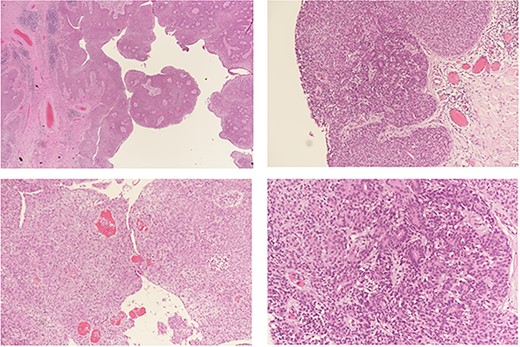 Histopathological analysis: a benign hemorrhagic neoplasm in the dermis with cystic change (a). The tumor is composed of two cell populations; small basaloid cells (b) and large pale cells (c) arranged in a solid fashion with tubular structure formation and numerous intra-lesional vessels (d) containing red blood