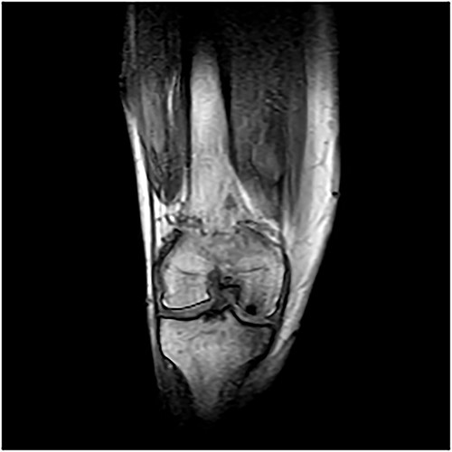 MRI images—osteochondral defect of the knee.