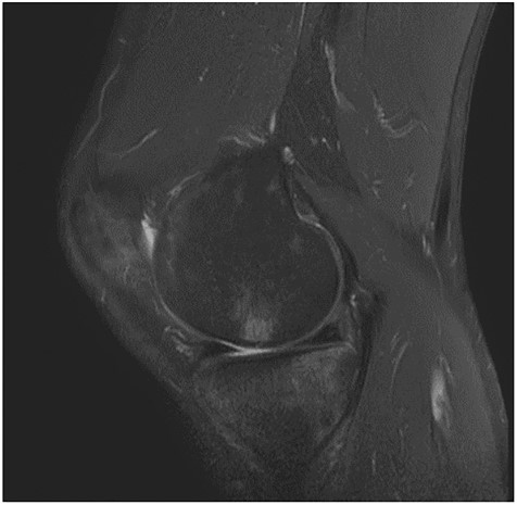 MRI images—osteochondral defect of the knee.