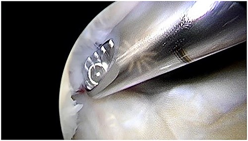 Shaver debridement.