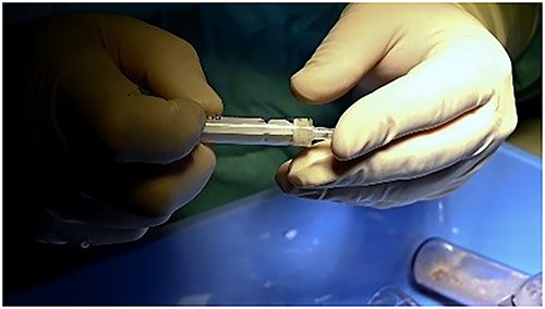Mixed cartilage.