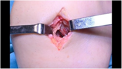 Cartilage application with fibrin glue.