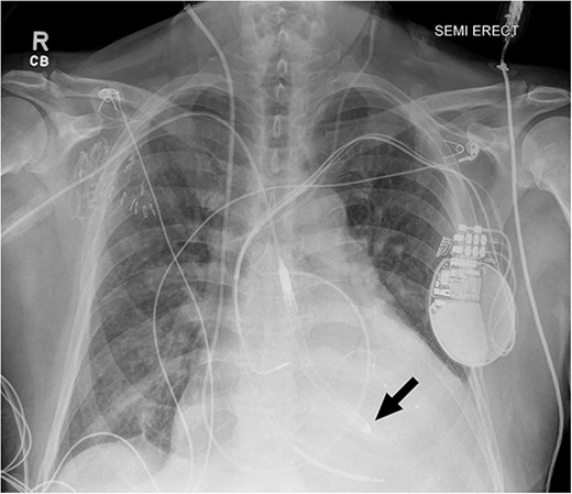 Chest radiograph after Impella 5.5® placement demonstrating adequate placement across the aortic valve into the left ventricle. The arrow indicates the tip of the Impella positioned in the left ventricle.