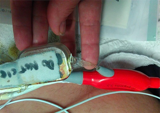 Break in the Impella 5.5 sidearm line from the reservoir to the device.