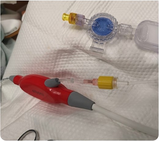 Removal of the purge reservoir and reestablishment of the purge line using a 20-gauge intravenous starter needle.