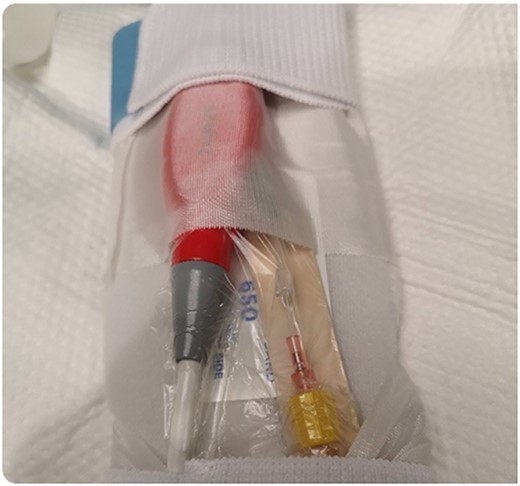Securing the Impella system after purge sidearm modification.