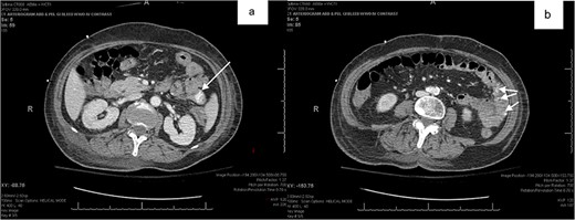 (a,b) abdominal CT with oral contrast identifying extravasation in the jejunal loop.