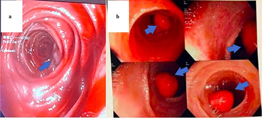 Endoscopic view of AVM identified in Patient 1 (a) and hamartomatous polyp in Patient 2 (b).