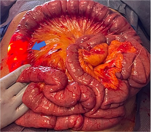 Transillumination of eviscerated small bowel during IOE.