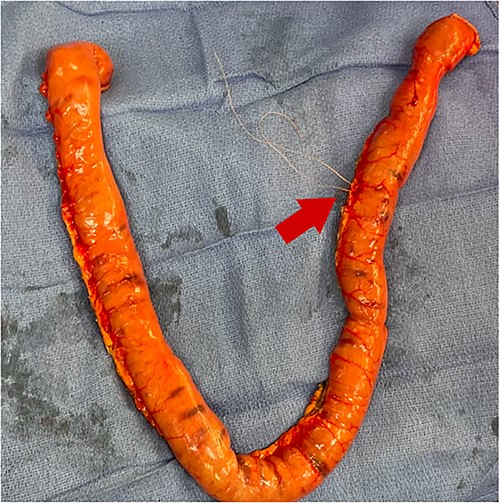 Small bowel resection specimen with 3–0 Vicryl suture marking (red arrow).