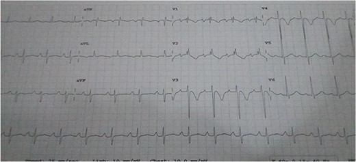 ECG of the patient.