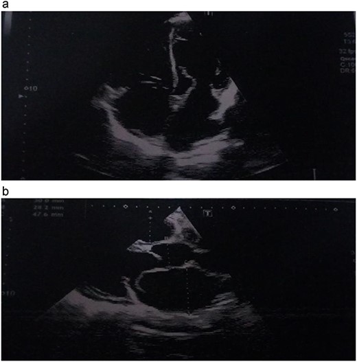 (a, b) Echocardiographic picture showing the avulsed papillary muscle.