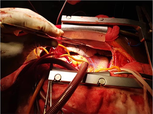 (a, b) Intraoperative pictures showing the deficient left hemi-pericardium.