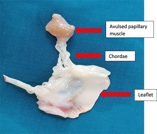 Excised mitral valve leaflet with the avulsed papillary muscle.