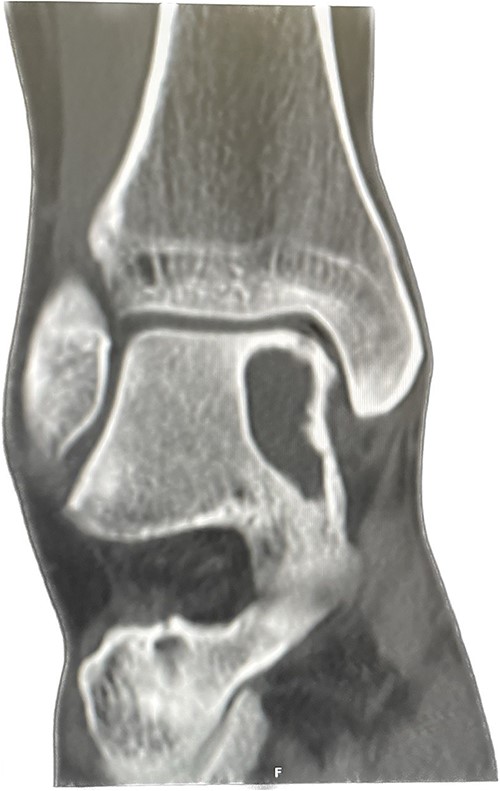 Pre-op Patient 1.