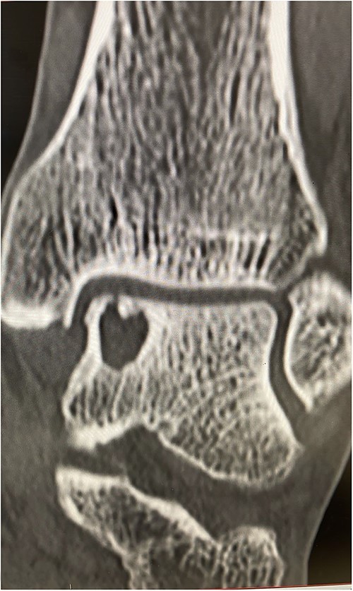 Pre-op Patient 2.