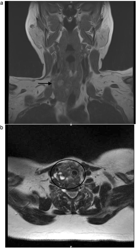 (a, b) Neck MRI, showing a mass 3 × 3.2 × 4.8 cm at the right thyroidectomy bed.