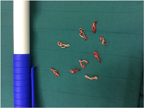 Specimen of the removed thick ligation sutures.