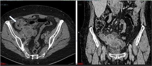 (a) Axial CT section of the abdomen showing signs of mucocele of the appendix with intraluminal air. (b) The coronal CT section of the appendix shows that the anterior wall of the appendix had an irregular thickening close to the transition of the middle/distal third.