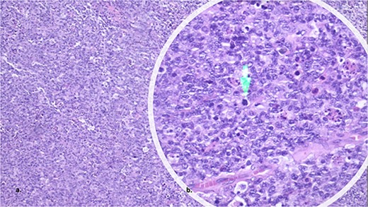 The histopathology showed a lymphoproliferative lesion of large and atypical cells with necrosis and hemorrhage, suggesting high-grade non-Hodgkin’s lymphoma.