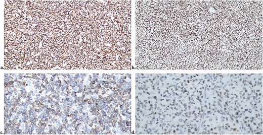 Immunohistochemistry of the lesion showed CD20, MUM1, BCL2 and BCL6 positive markers (a, b, c and d, respectively).
