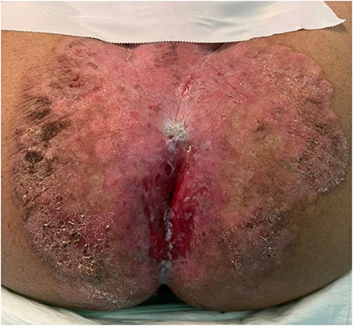 Preoperative lesion.