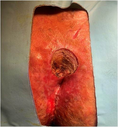 After excision of the lesion during the second operation.