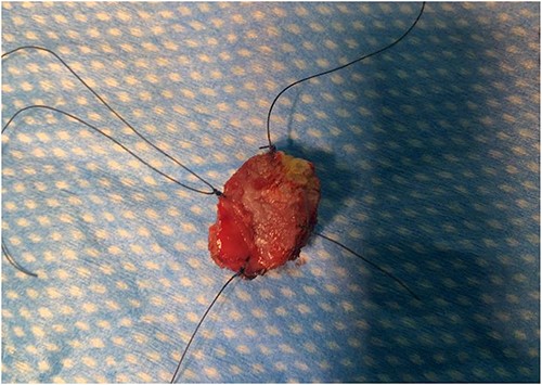 Lesion excised from the 10 o’clock position.