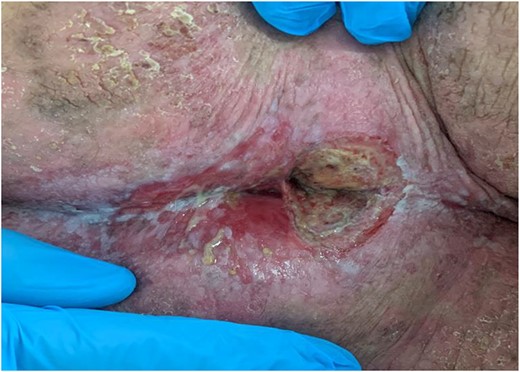 One week postoperatively.