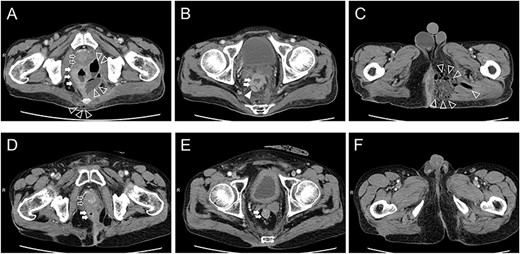 Computed tomography findings upon admission (A–C) and 1 year after chemoradiotherapy (D, E). Prostate level (A, D): The prostate, pelvic cavity and coccyx were invaded by the rectal tumor, fluid and gases (A). The rectal tumor clearly shrank, and only inflammatory scars remained (D). Seminar vesicle level (B, E): Lymph nodes around the superior rectal artery were swollen (B). Swollen lymph nodes disappeared (E). Perineal level (C, F): Fluid and gases extended to the left side of the perineal area (C). Only inflammatory scars remained (F). Open arrow: prostate, closed arrow: rectum, open arrowhead: fluid and gases, closed arrowhead: lymph nodes.