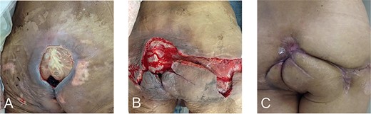 Wounds and scars after debridement. The wound during primary debridement (A) and additional debridement upon the relapse of NF (B), which healed about 9 months later (C).