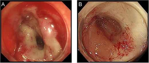 Colonoscopy findings before (A) and at 12 months after CRT (B).