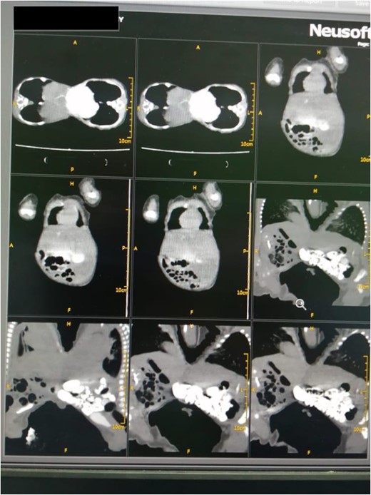 Abdominal computed tomography revealed a fusion of the liver through a large isthmus with normal liver and without vascular connections.
