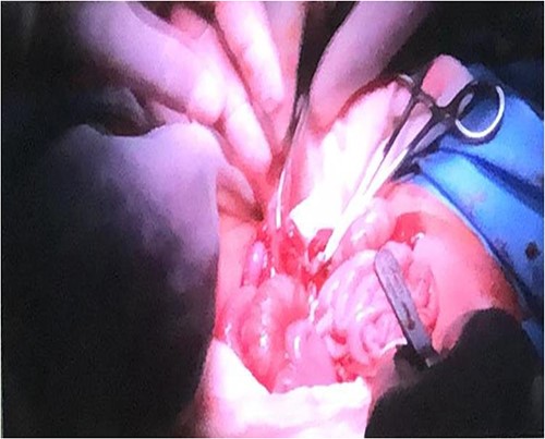 Connections within parietal peritoneum were identified and then carefully divided, followed by the connecting part of the liver.