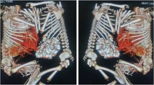 CT scan with contrast of case 2 showed omphalopagus type of conjoined twins with fusion of anterior aspect of the livers and separate other vital organs.