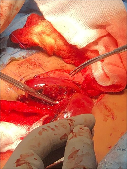 Separation of the shared liver in case 2.