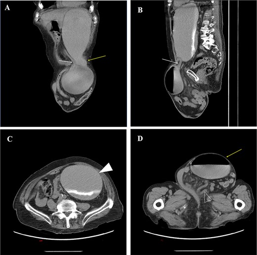 (A) oblique coronal reconstructions from a non-contrast CT demonstrates the gastric body (yellow arrow) entering the left inguinal hernia, and the obstructed gastric antrum (white arrow) exiting the hernia; (B) oblique sagittal reconstruction from a CT demonstrates the obstructed gastric antrum (white arrow); (C) axial non-contrast CT through the abdomen demonstrates a dilated gastric body and fundus (white arrowhead) with layering contrast fluid and ingested material; (D) axial non-contrast CT image through the pelvis demonstrates a large left inguinal hernia containing the obstructed gastric body (yellow arrow) and multiple loops of decompressed small bowel (open arrowhead).