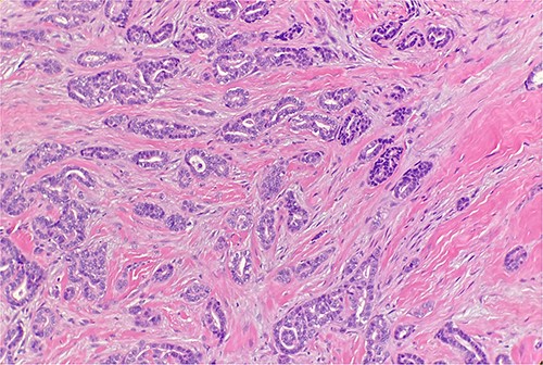 Microscopic examination reveals infiltrative malignant glands with angulated contours. H&E ×20.