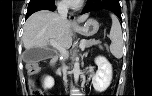 Abdominal CT revealed CBD stone resulting in upstream biliary dilatation and acute cholecystitis.