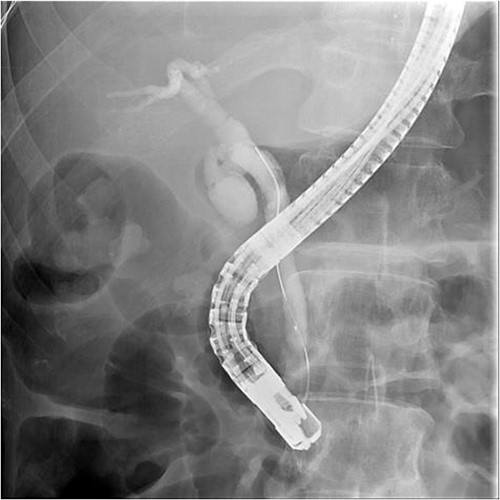 Successful wireguide CBD cannulation to pass through the opacified CBD stone following by cholangiography.