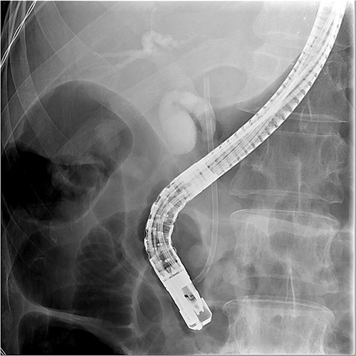 Fluoroscopy image showed the plastic stent penetrated through the CBD.