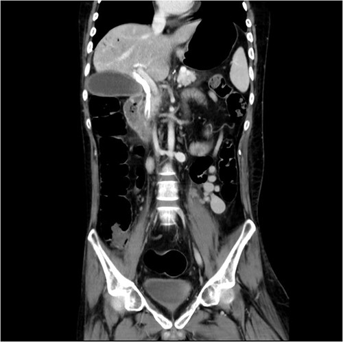 Just after ERCP, the abdominal CT showed retained contrast medium in bile duct.