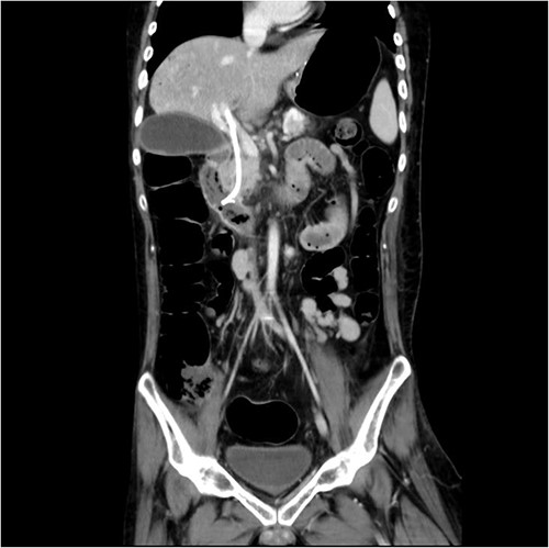 Malposition of the CBD internal stent with upper portion in main portal vein.