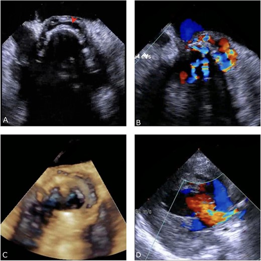 Preoperative TEE: (A) Red arrow pointing at a paravalvular anechoic free space around the prosthetic mechanical aortic valve. (B) Echo image showing paravalvular regurgitation and leakage around the prosthetic mechanical valve. (C) 3D reconstructive echocardiography image showing paravalvular free space around the aortic mechanical valve at 3–9 o’clock with aneurysmal echo free space at the aortomitral curtain protruding into left atrium. (D) Aortic prosthetic mechanical valve dehiscence causing aortic stenosis with moderate paravalvular regurgitation.